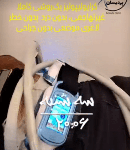 نمونه کرایولیپولیز لاغری کلینیک پردیسان