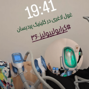 نمونه کرایولیپولیز لاغری کلینیک پردیسان