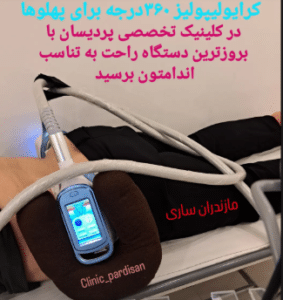 نمونه کرایولیپولیز لاغری کلینیک پردیسان