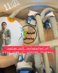 نمونه کرایولیپولیز لاغری کلینیک پردیسان