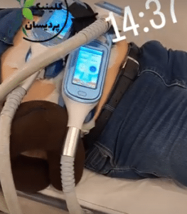 نمونه کرایولیپولیز لاغری کلینیک پردیسان