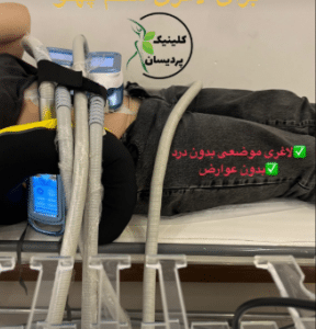نمونه کرایولیپولیز لاغری کلینیک پردیسان