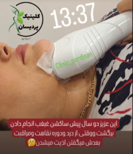 نمونه کرایولیپولیز لاغری کلینیک پردیسان