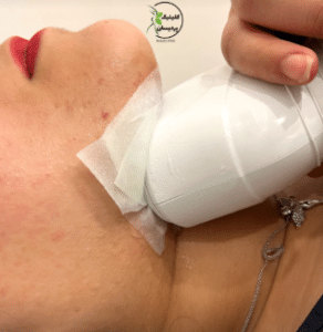 نمونه کرایولیپولیز لاغری کلینیک پردیسان