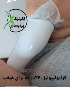 نمونه کرایولیپولیز لاغری کلینیک پردیسان