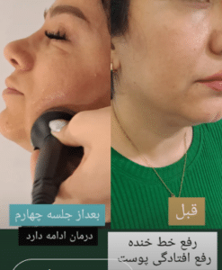 نمونه آر اف لاغری کلینیک پردیسان