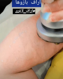 نمونه آر اف لاغری کلینیک پردیسان