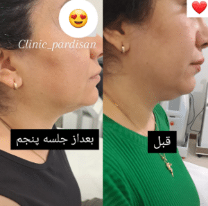 نمونه آر اف لاغری کلینیک پردیسان