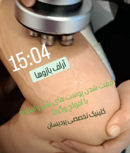 نمونه آر اف لاغری کلینیک پردیسان