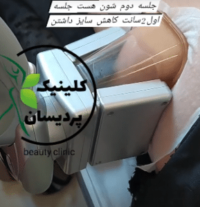 نمونه کرایولیپولیز لاغری کلینیک پردیسان