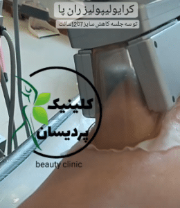 نمونه کرایولیپولیز لاغری کلینیک پردیسان