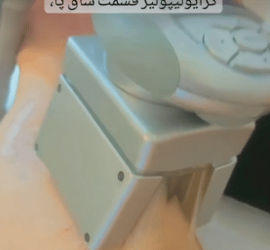 نمونه کرایولیپولیز لاغری کلینیک پردیسان