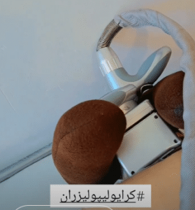 نمونه کرایولیپولیز لاغری کلینیک پردیسان