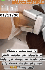 نمونه کرایولیپولیز لاغری کلینیک پردیسان