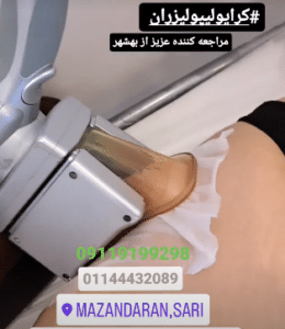 نمونه کرایولیپولیز لاغری کلینیک پردیسان