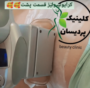 نمونه کرایولیپولیز لاغری کلینیک پردیسان