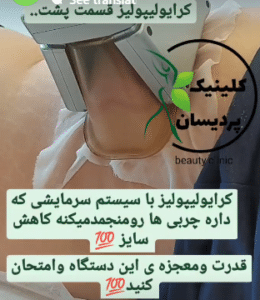 نمونه کرایولیپولیز لاغری کلینیک پردیسان