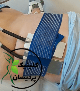 نمونه کرایولیپولیز لاغری کلینیک پردیسان