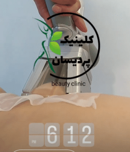 نمونه کرایولیپولیز لاغری کلینیک پردیسان