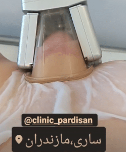 نمونه کرایولیپولیز لاغری کلینیک پردیسان