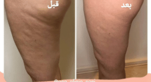 نمونه کویتیشن لاغری مرکز لاغری آسا