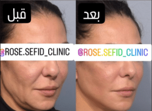 نمونه هایفو لاغری مرکز لاغری آسا