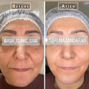 نمونه هایفو لاغری مرکز لاغری آسا