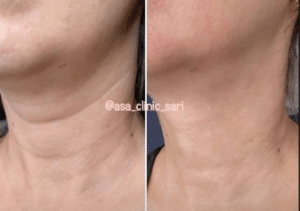 نمونه هایفو لاغری مرکز لاغری آسا