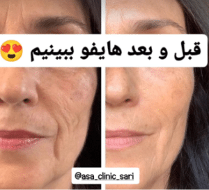 نمونه هایفو لاغری مرکز لاغری آسا