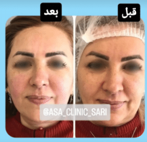 نمونه هایفو لاغری مرکز لاغری آسا