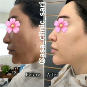 نمونه هایفو لاغری مرکز لاغری آسا