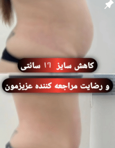 نمونه کرایولیپولیز لاغری مرکز لاغری آسا