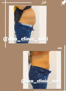 نمونه کرایولیپولیز لاغری مرکز لاغری آسا