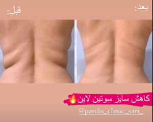 نمونه لاغری موضعی مرکز لاغری پردیس