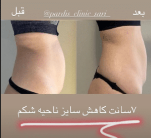 نمونه لاغری موضعی مرکز لاغری پردیس