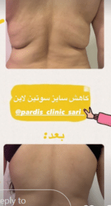 نمونه لاغری موضعی مرکز لاغری پردیس