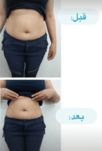 نمونه لاغری موضعی مرکز لاغری پردیس