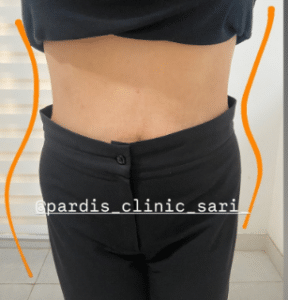 نمونه لاغری موضعی مرکز لاغری پردیس