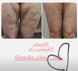 نمونه لاغری موضعی مرکز لاغری پردیس