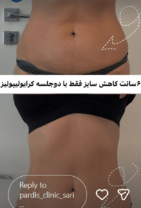 نمونه لاغری موضعی مرکز لاغری پردیس