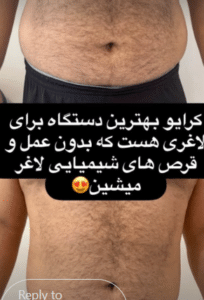 نمونه لاغری موضعی مرکز لاغری پردیس