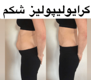 نمونه لاغری موضعی مرکز لاغری پردیس