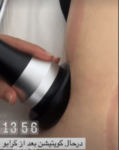 نمونه لاغری موضعی مرکز لاغری پردیس