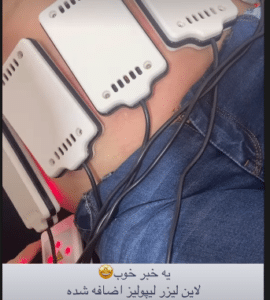 نمونه لاغری موضعی مرکز لاغری پردیس