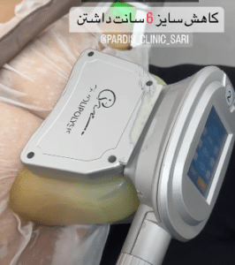 نمونه لاغری موضعی مرکز لاغری پردیس