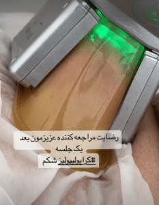 نمونه لاغری موضعی مرکز لاغری پردیس