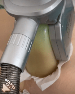 نمونه لاغری موضعی مرکز لاغری پردیس