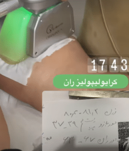 نمونه لاغری موضعی مرکز لاغری پردیس