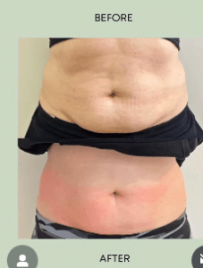 نمونه لاغری موضعی مرکز لاغری پردیس