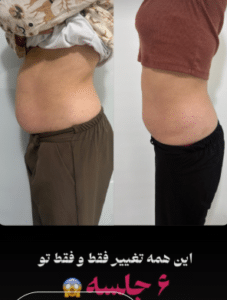 نمونه لاغری موضعی دکتر محمدامین صنعتی